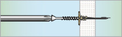 Illustration av en kateter som går genom en artär med en stent placerad i änden.